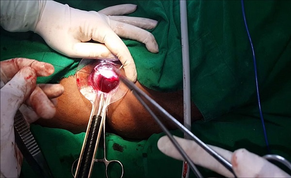 Sau khi thực hiện phẫu thuật cắt trĩ, người bệnh thường phải đối mặt với cảm giác đau, ra máu đỏ cục, đại tiện bất thường,...