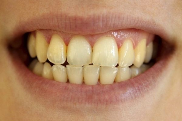 Tẩy trắng răng sau khi sinh có được không?