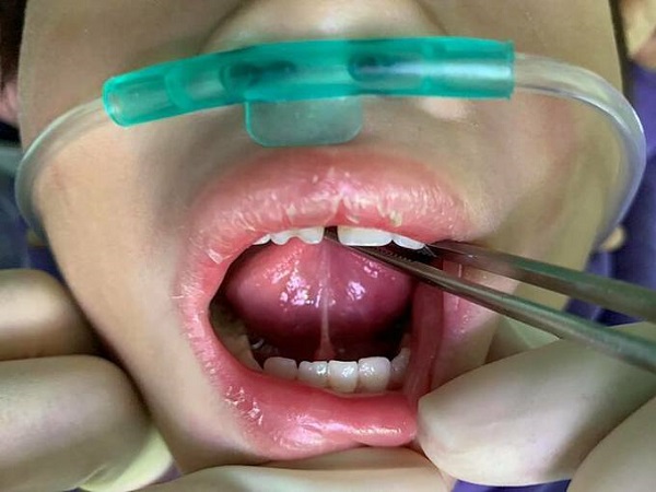 Với thắc mắc cắt dính thắng lưỡi có đau không thì câu trả lời là không vì đây chỉ là một tiểu phẫu nhỏ, đơn giản