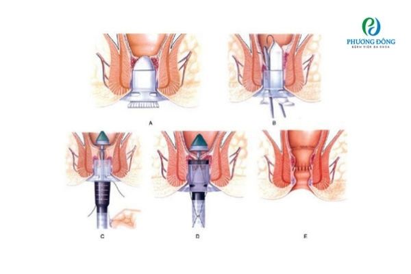 Quy trình các bước phẫu thuật trĩ bằng kỹ thuật Longo