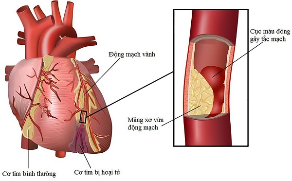 Nhồi máu cơ tim là bệnh lý cực kỳ nguy hiểm cần điều trị ngay
