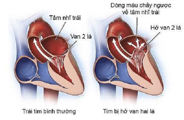 Hở van 2 lá là một trong các bệnh lý thường gặp ở tim