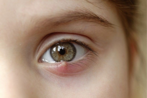 Lẹo mắt khiến người bệnh thấy khó chịu vì nó sưng đỏ, đau nhức và ngứa