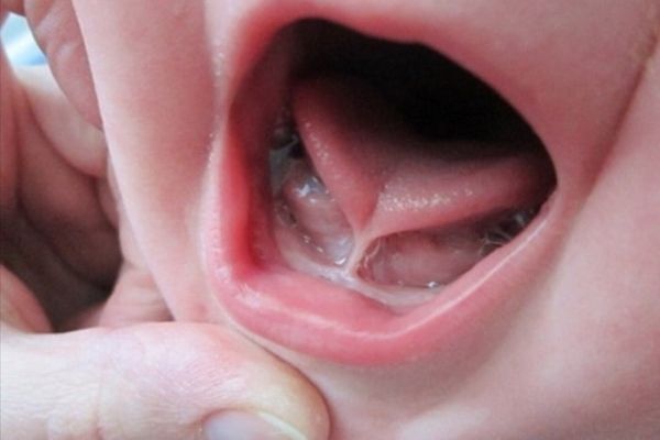 Dính thắng lưỡi là dị tật thường xuất hiện ở trẻ sơ sinh