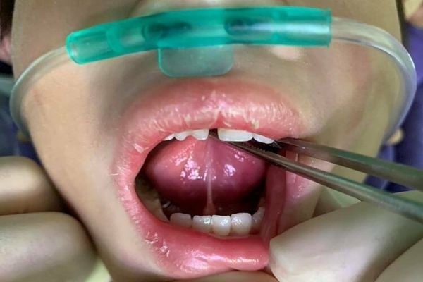 Phẫu thuật dính thắng lưỡi là phương pháp không quá phức tạp