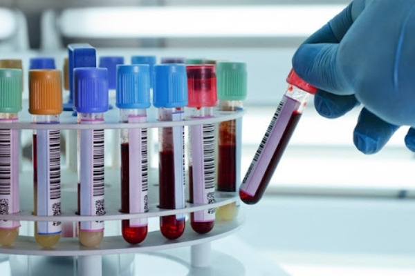 Chẩn đoán suy gan bằng xét nghiệm máu
