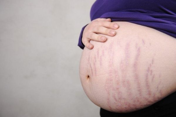 Các vết rạn xuất hiện nhiều và tăng lên khi mẹ bầu tăng cân theo các tháng của thai kỳ