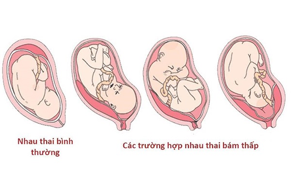 4. Rau bám đáy tử cung và quá trình sinh nở