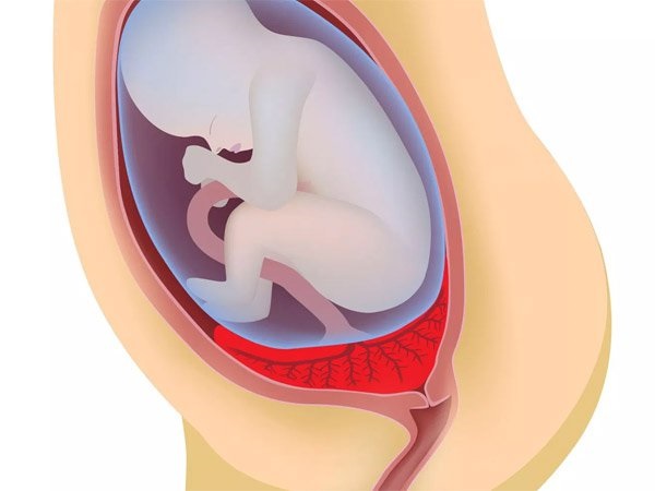 Rau tiền đạo là tình trạng nhau thai che một phần hoặc toàn bộ lỗ mở của tử cung