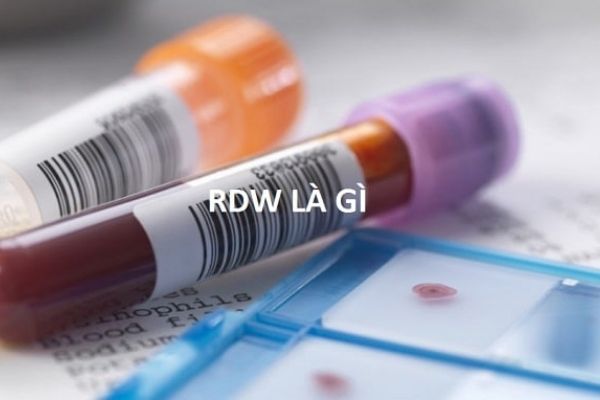 Chỉ số RDW là gì? Đây là thông số đánh giá sự phân bổ hồng cầu trong máu