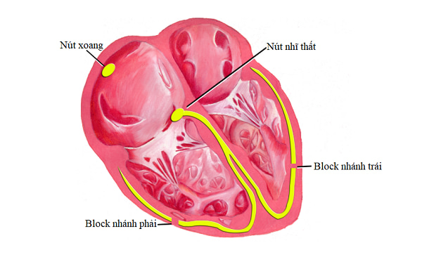 Hình ảnh mô tả tình trạng block tim nhánh phải và block tim nhánh trái