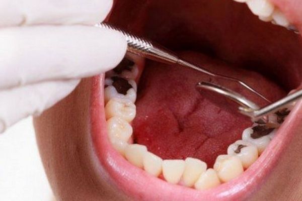 Người bị sâu răng không nên làm trắng răng bằng công nghệ laser