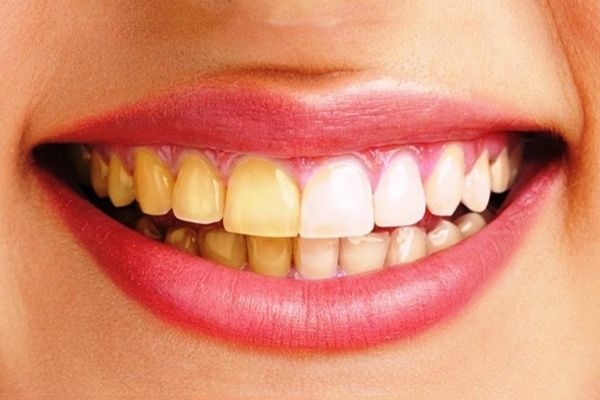 Những người có hàm răng ố vàng, xỉn màu nên thực hiện tẩy trắng răng