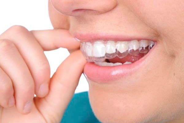 Tẩy trắng răng bằng máng thuốc tại nhà được nhiều người áp dụng