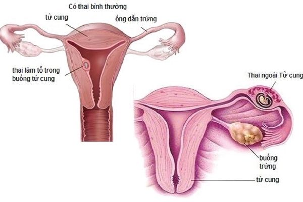 Hình ảnh thai làm tổ trong buồng tử cung và thai ngoài tử cung