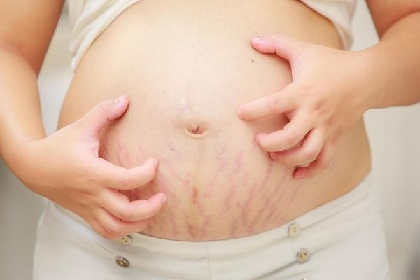 Rạn da khi mang thai là hiện tượng diễn ra khi mẹ bầu tăng cân nhanh chóng