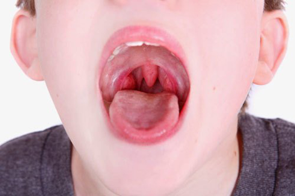 Hình ảnh cổ họng của trẻ khi bị nhiễm trùng.
