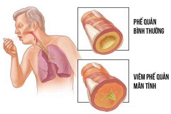 Bệnh viêm phế quản xảy ra khi tình trạng viêm nhiễm xảy ra tại lớp niêm mạc ống phế quản