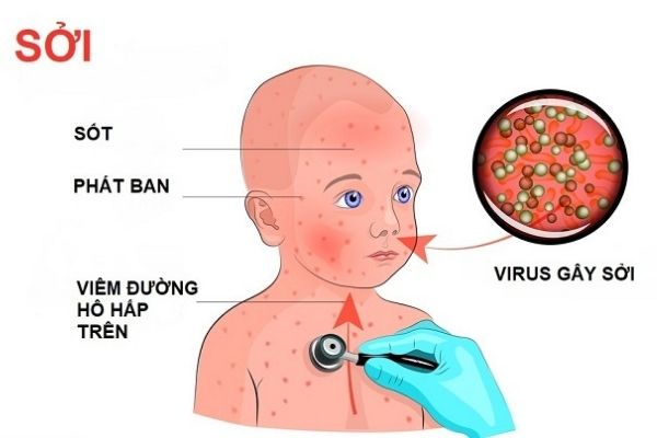 Bệnh sởi ở trẻ em lây nhiễm trực tiếp khi người bệnh ho hoặc hắt hơi