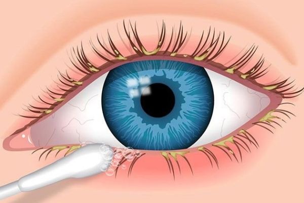 Viêm kết mạc do virus gây ra có thể là nguyên nhân gây bệnh chắp và lẹo mắt