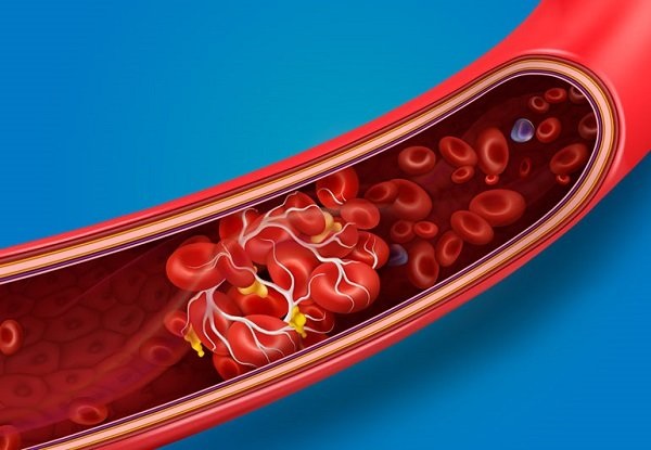 Tác động của bệnh đa hồng cầu đến cơ thể như thế nào?
