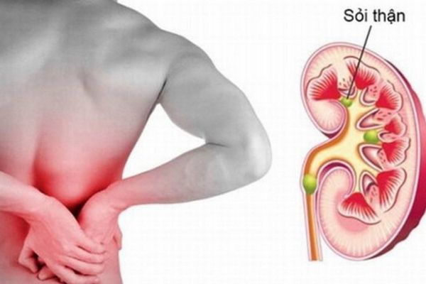 Đau vùng hố thắt lưng là một trong những biểu hiện của bệnh sỏi thận