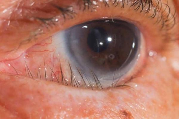 Hình ảnh về bệnh đau mắt hột khiến lông mi mọc ngược