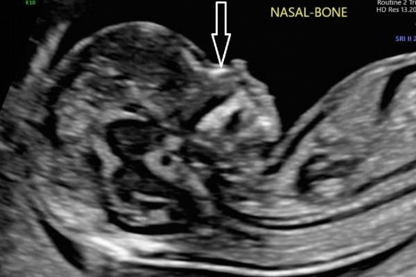 Đo chiều dài xương mũi cho thai nhi được thực hiện vào tuần thai thứ 11
