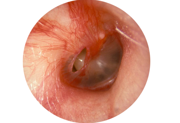 Hình ảnh màng nhĩ bị thủng do viêm tai giữa lâu ngày hoặc trong quá trình điều trị bệnh.