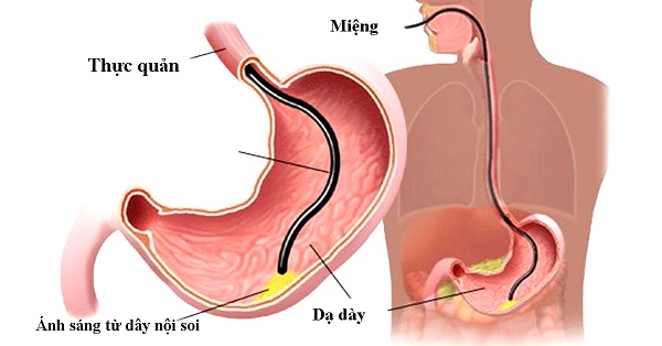 Hình ảnh minh họa quá trình nội soi dạ dày - tá tràng