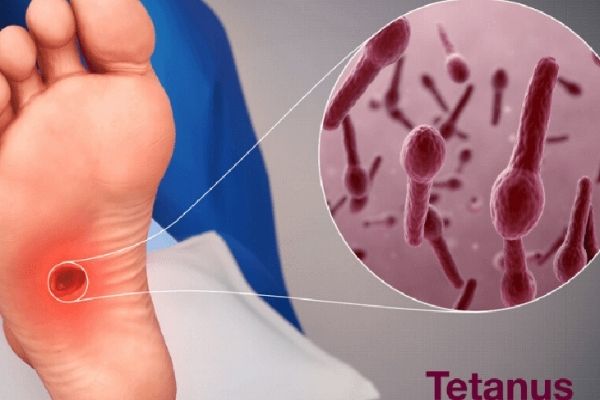 Uốn ván là bệnh nhiễm trùng cấp tính gây ra bởi trực khuẩn Clostridium Tetan