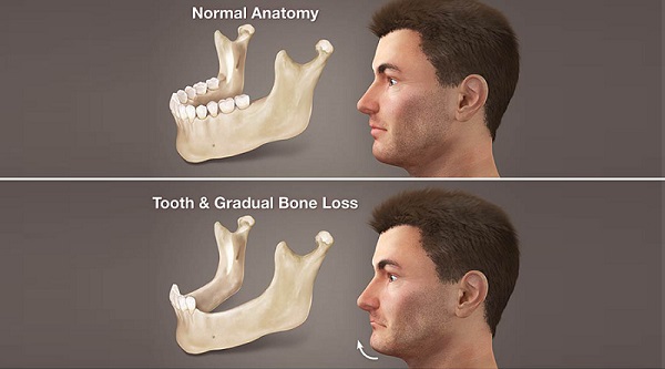 Trồng răng bằng cấy ghép implant giúp đẩy lùi biến chứng tiêu xương hàm do mất răng
