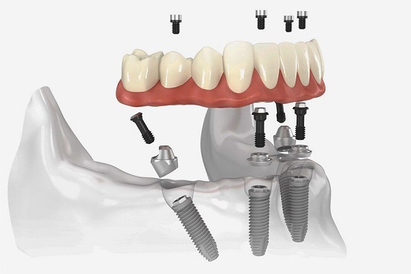 Trồng răng implant chắc chắn sẽ gây ra cảm giác khó chịu cho người bệnh trong vài ngày đầu