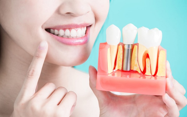Trồng răng implant giá bao nhiêu phụ thuộc vào nhiều yếu tố