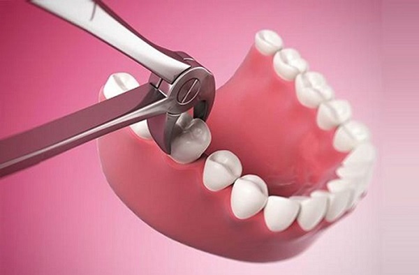 Sau khi nhổ răng bao lâu thì trồng implant tùy thuộc vào chỉ định của bác sĩ trong từng trường hợp