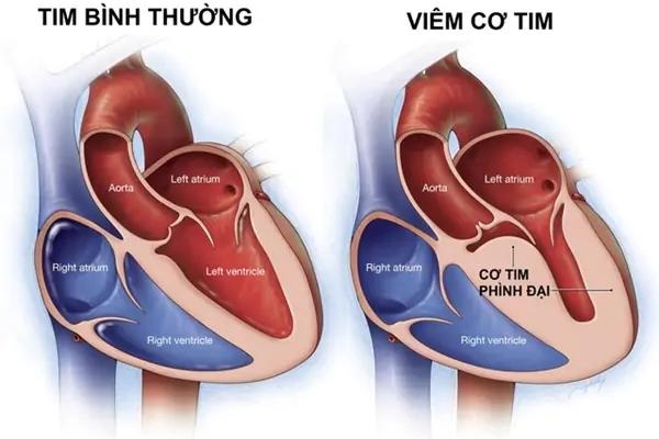 Viêm cơ tim cũng là bệnh lý gây ra tình trạng đau nhói ngực bên phải