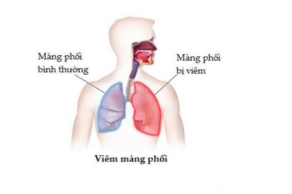 Hiện tượng đau ngực phải có thể là do bị viêm màng phổi
