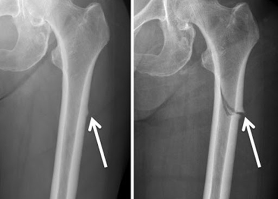 Chụp X-quang là phương pháp chẩn đoán bệnh loãng xương hiệu quả