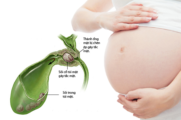 Đau bụng trên khi mang thai tháng cuối có thể là dấu hiệu cảnh báo vấn đề về túi mật