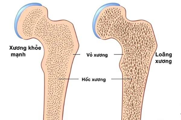 Loãng xương là tình trạng cấu trúc rỗng trong xương tăng lên