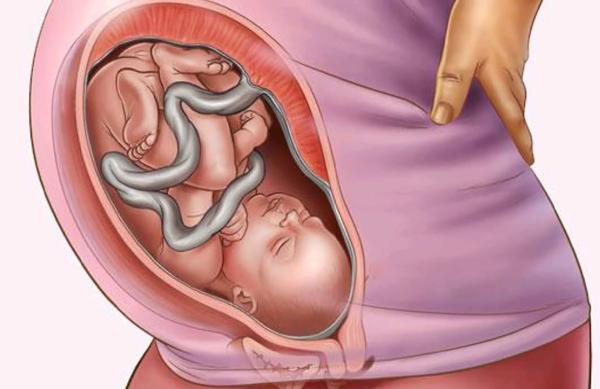 Dây rốn quấn cổ 1 vòng tuần 35 có nguy hiểm không là thắc mắc của nhiều mẹ bầu