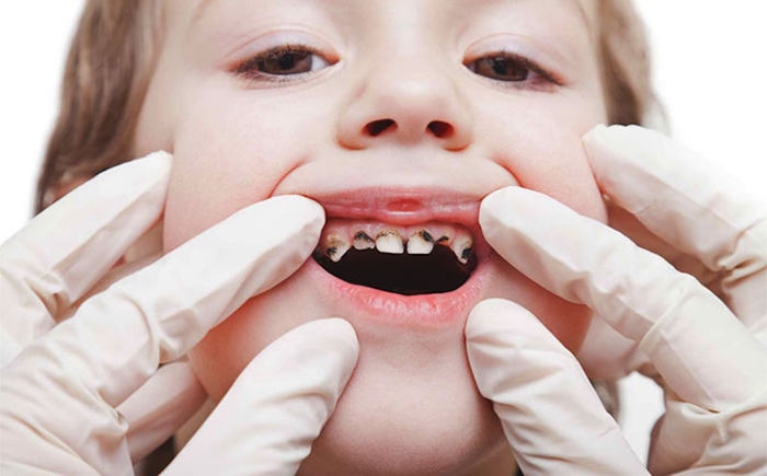 Sâu răng là bệnh lý rất phổ biến ở trẻ nhỏ