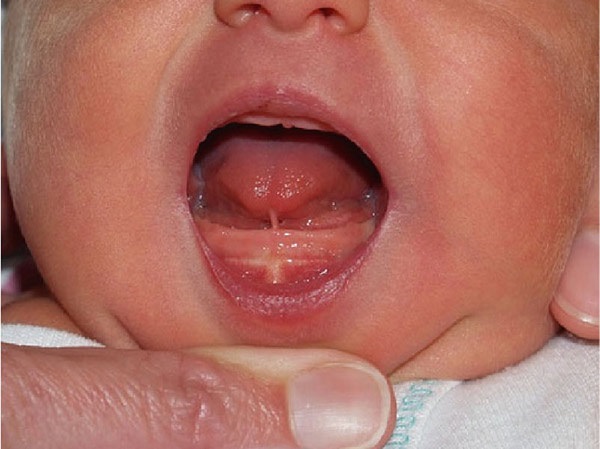 Dị tật dính thắng lưỡi ở trẻ: Dấu hiệu nhận biết, phương pháp và địa chỉ điều trị uy tín