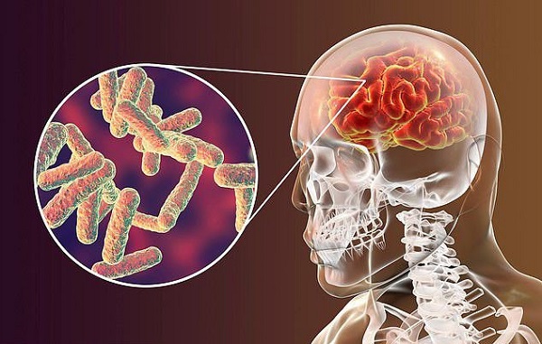 Vi khuẩn phế cầu là tác nhân gây bệnh viêm màng não