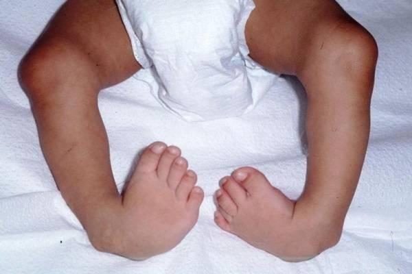 Khoèo bàn chân ảnh hưởng đến khả năng vận động của trẻ