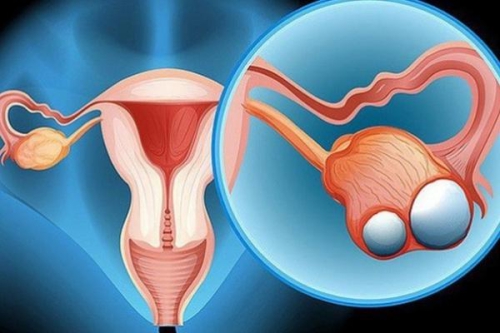 Ung thư Buồng trứng: dấu hiệu nhận biết sớm và cách điều trị giúp phụ nữ khỏe mạnh