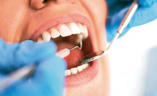 Có nên nhổ răng khôn hàm trên?