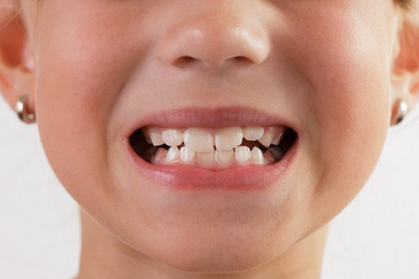 Hàm răng bị mài mòn, mất cân đối là dấu hiệu nhận biết trẻ ngủ nghiến răng