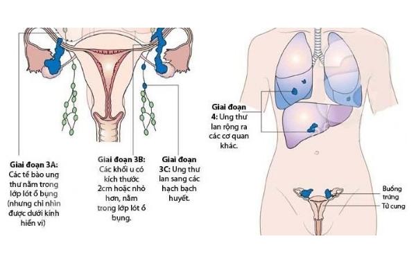 Biểu hiện của ung thư buồng trứng ở giai đoạn 3 và 4