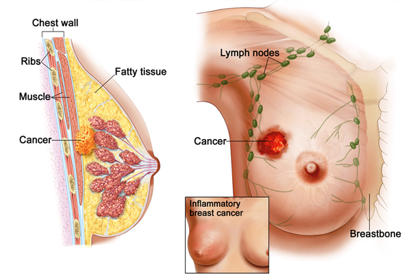 Hình ảnh mô tả tế bào ung thư đã xuất hiện ở vú.